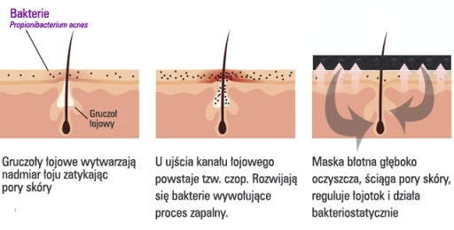 SEBORATHE AKNÉ Pimples MASKA MŔTVYM MOROM BLATO BIELY ÍL ZINOK