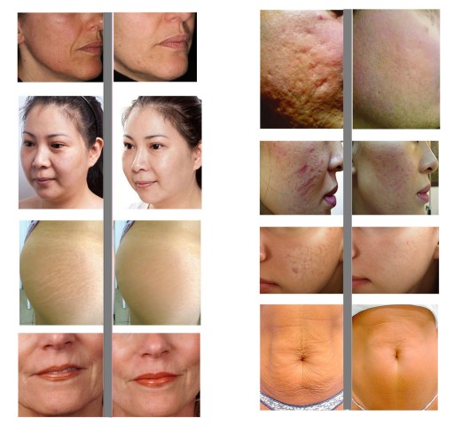 Derma Roller Ihlová mezoterapia na strie 0,5 mm