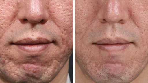 Náplne s membránou pre permanentný make-up 1RL