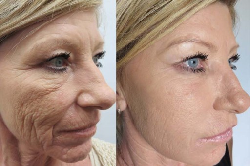 Náplne s membránou pre permanentný make-up 1RL