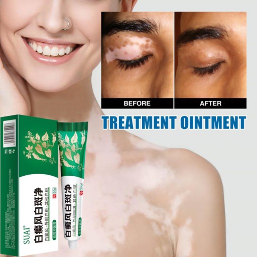 Vitiligo krém Suai Vitiligo 20g