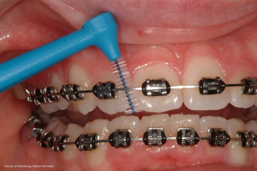 Tepe Angle medzizubné kefky 0,6mm 6 ks.