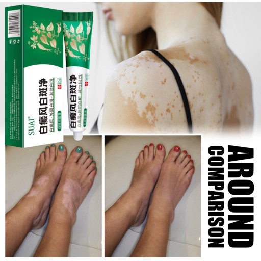 Vitiligo krém Suai Vitiligo 20g