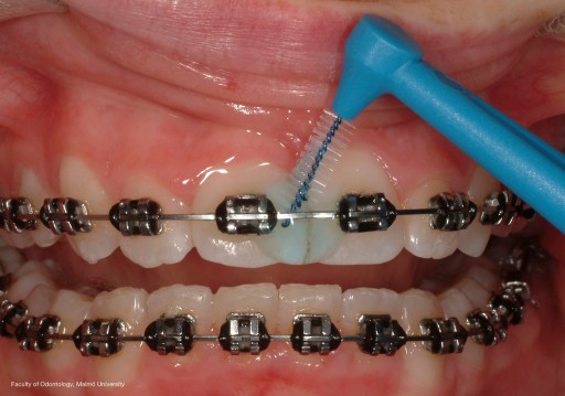 Tepe Angle medzizubné kefky 0,6mm 6 ks.