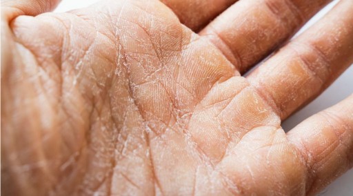 Hydratačný krém pre veľmi suchú pleť s vitamínom A a E, vyrovnáva farbu