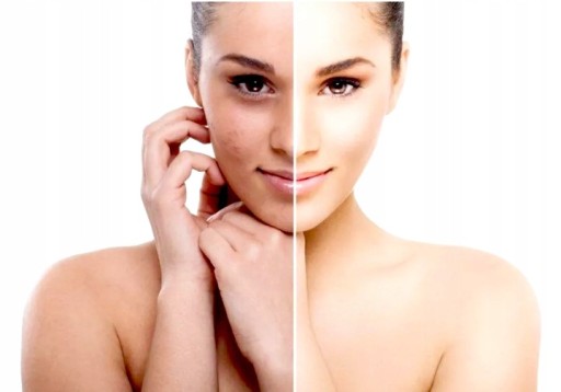 KYSELINOVÝ PEELING PRE NEDOKONALOSTI A ODFARENIA DERMEN KYSELNÝ PEELING