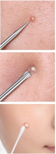 Lyžica Unny Hook Blackheads Blackheads