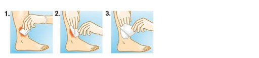 Suprasorb A alginátový obväz 5x5cm 1 ks použiť aj ako tamponáda