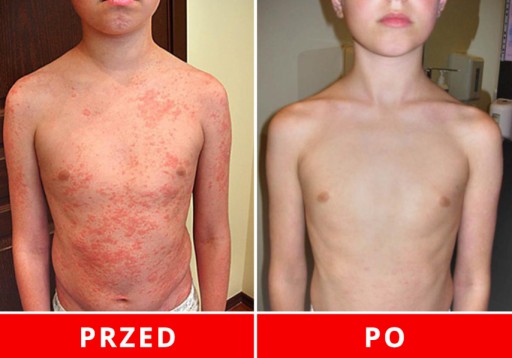 EGYPTSKÝ MAGICKÝ KRÉM NA psoriázu, ÚČINNE ÚČINNÝ