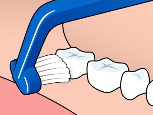 Ortodontická zubná kefka TePe Universal Care na čistenie implantátov