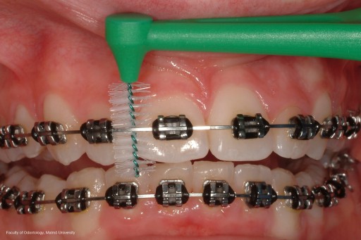 Tepe Angle medzizubné kefky 0,8mm 6 ks.