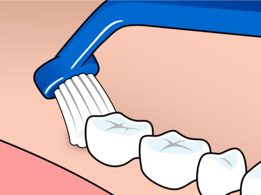 Ortodontická zubná kefka TePe Universal Care na čistenie implantátov