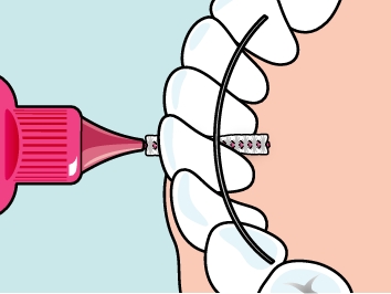 TePe Original medzizubné kefky 0,4 mm