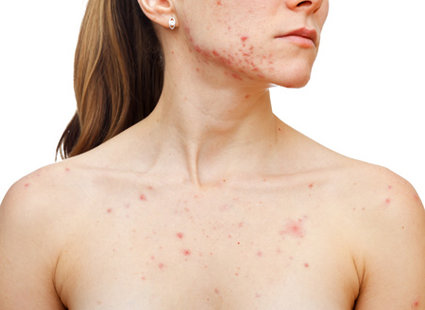 Kozmetická dezinfekcia LADY Salicylic 70%