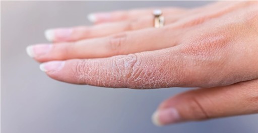 Hydratačný krém pre veľmi suchú pleť s vitamínom A a E, ktorý vyrovnáva tón pleti