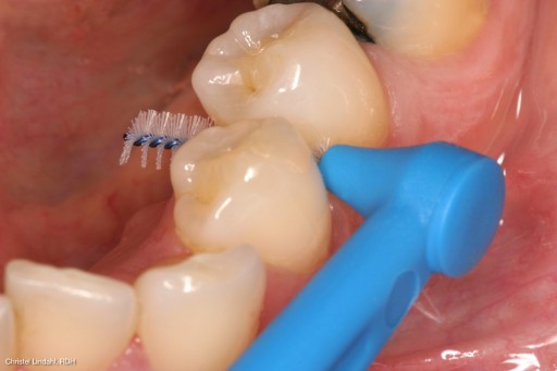 Tepe Angle medzizubné kefky 0,6mm 6 ks.