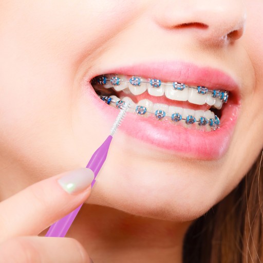 100 ortodontických zubných kefiek - praktická a ľahká hygienická sada