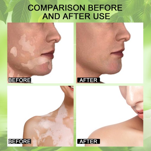 Vitiligo krém Suai Vitiligo 20g