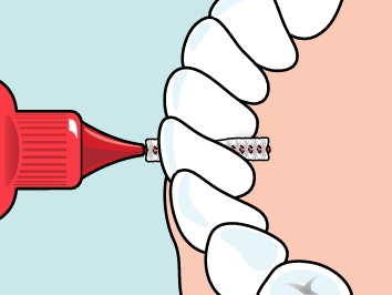 TePe Original medzizubné kefky 0,5 mm